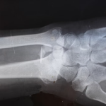 How Orthopedic Healthcare Investing Can Benefit You Orthopedic Healthcare