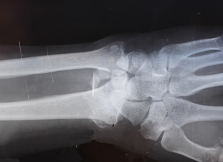 How Orthopedic Healthcare Investing Can Benefit You Orthopedic Healthcare